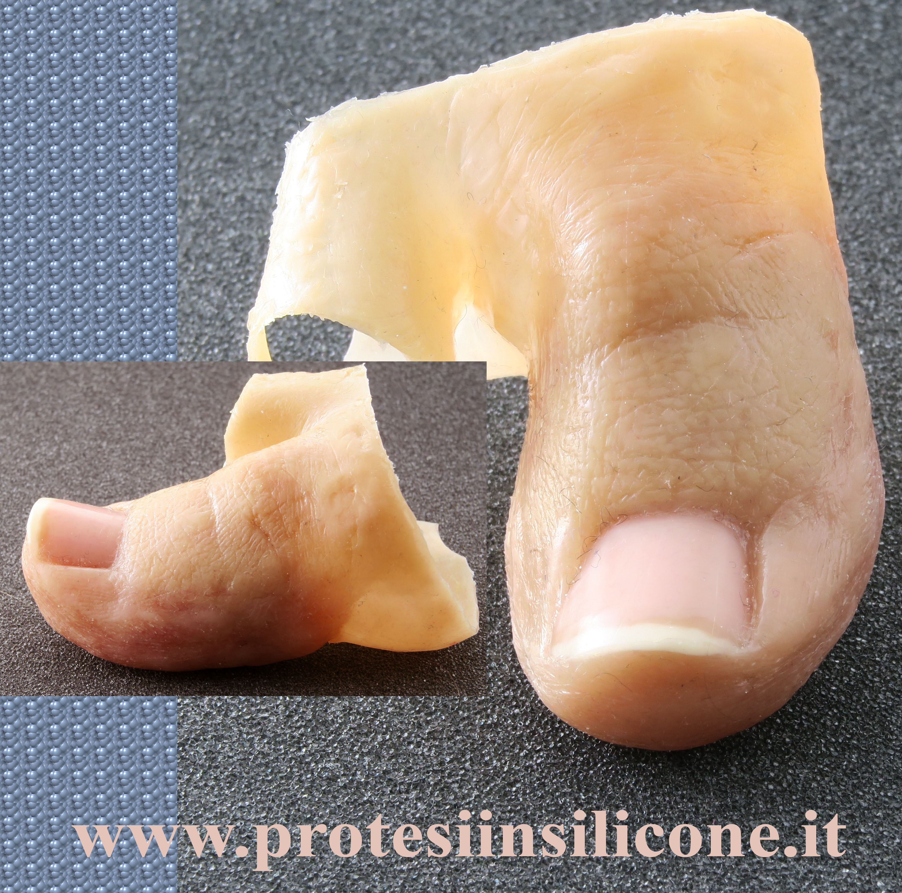 protesi per dito di piede, amputazioni in seguito a vasculopatie e diabete