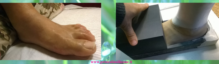 3D printing silicone cosmesis